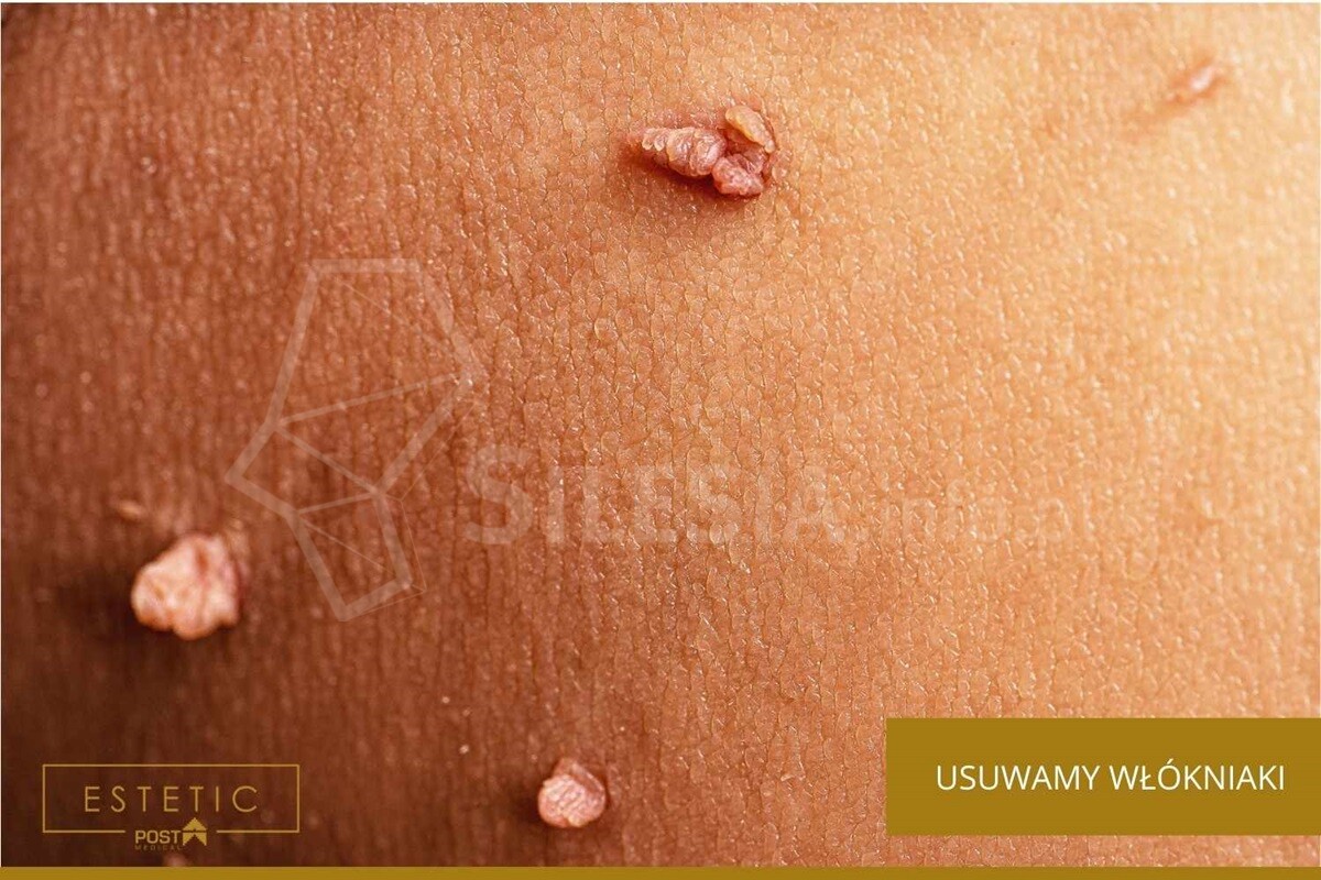 Usuwanie włókniaków i brodawek w Katowicach? Dojedziesz do nas w 20 minut.